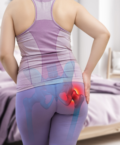 Piriformis sindrom-slika