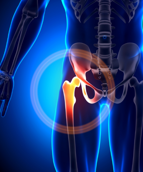 Poškodbe labruma kolka-slika