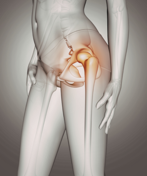 Sindrom pokanja v kolku-slika