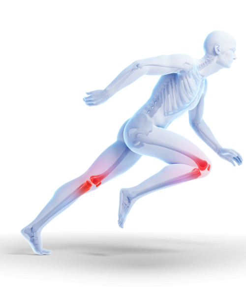 Tendinitis-slika