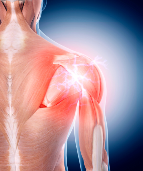 poskodba supraspinatusa naslovna